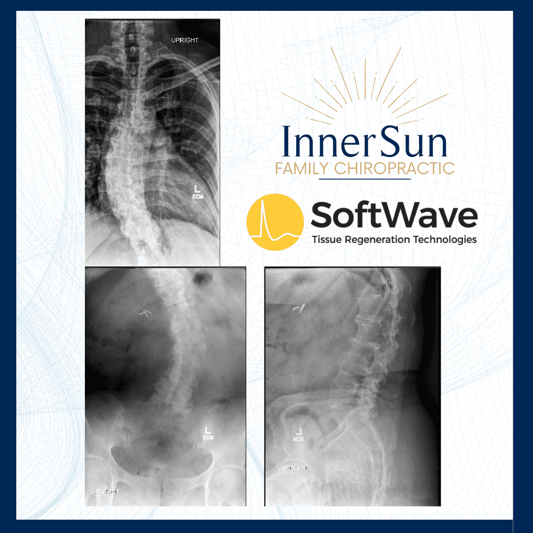Lisa's Journey: Overcoming Chronic Back Pain with SoftWave TRT