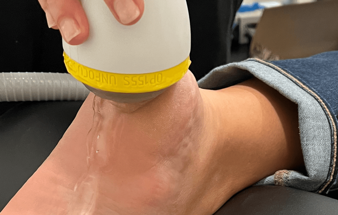 Overcoming Achilles Tendonitis with SoftWave Therapy at InnerSun Family Chiropractic in Roanoke, VA