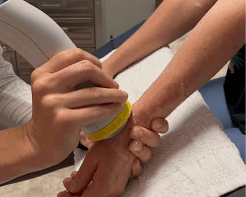 Can SoftWave Therapy Be the Answer to Your Hand and Wrist Pain?